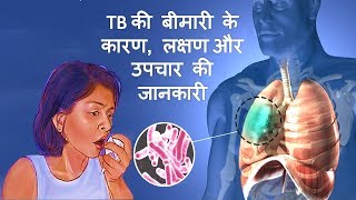 Tuberculosis TB के कारण लक्षण और उपचार – Tuberculosis Causes Symptoms amp Treatment in Hindi [upl. by Assirol]