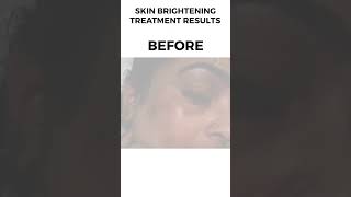 Skin Brightening Treatment Before amp After Result Shared By American Aesthetic skinbrightening skin [upl. by Us497]