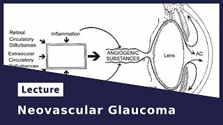 Neovascular Glaucoma [upl. by Dodi]