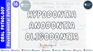 Hypodontia  Anodontia  Oligodontia  Developmental disturbances of teeth  Dr Paridhi Agrawal [upl. by Allister]