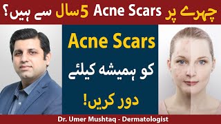 Treatments for ACNE SCARS Kaise Hataye  Acne Scars Removal  How To Remove Acne Scars [upl. by Niras191]