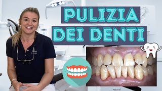 Come funziona la PULIZIA dei DENTI dal dentista [upl. by Nawak755]