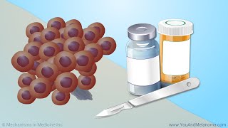 Treating Melanoma [upl. by Enyala]