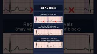 21 Atrioventricular Block ECG [upl. by Madelena940]