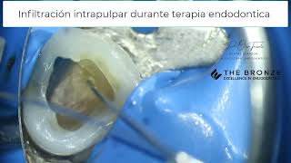 Anestesia intrapulpar durante terapia endodontica [upl. by Aluin559]