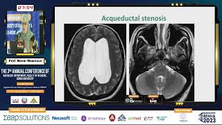 MRI CSF Flowmetry [upl. by Sherline]