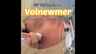 RF lifting Volnewmer [upl. by Sulohcin]