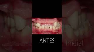 Implantes dentales  Antes y después [upl. by Ancilin312]