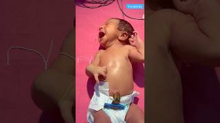 Abdominal Distension 😱medical viralvideo [upl. by Naresh]