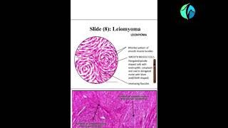 TUMOR SECTION  DRFATMA HAMDAN [upl. by Ennaerb]