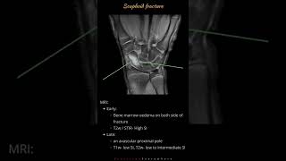 Scaphoid fracture  Wrist bone fractures  Radiology tutorials by Radiology Everywhere [upl. by Roxanne]