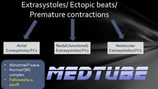 ECGs abnormal rhythms Extrasystoles [upl. by Rj694]