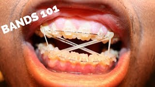 How Do Braces Bands Work Elastics [upl. by Asilej]