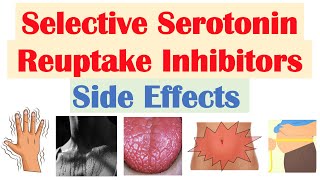 SSRI Antidepressant Side Effects amp Why They Occur  Fluoxetine Paroxetine Sertraline Citalopram [upl. by Leinto]