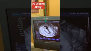 10 Week Baby 😱😱  USG  Bsc Nursing Students life youtubeshorts trendingshorts ytshorts shorts [upl. by Adamok]