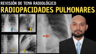 Revisión de Tema 88 Radiopacidades pulmonares [upl. by Lonyer]