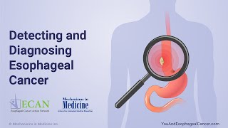 Detecting and Diagnosing Esophageal Cancer [upl. by Giarc134]