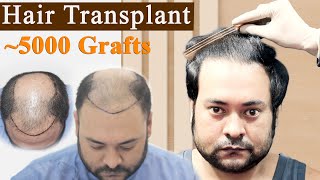 Hair Transplant in India  Results Natural Hairline Grade 7  Dr Suneet Soni  Medispa India [upl. by Crompton]