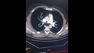 CT pulmonary embolism [upl. by Aiepoissac]