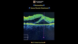 Retinoschisis Serous Macular Detachment [upl. by Naesyar]