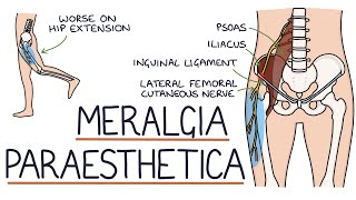 Understanding Meralgia Paraesthetica [upl. by Cyrille]