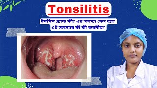 Tonsillitis In Bengali  Causes  Symptoms  Home Remedies  Treatments [upl. by Long]