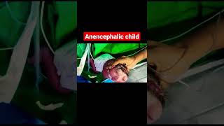 Anencephalic child bscnursing jlnmch [upl. by Wooldridge]