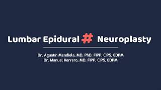 Lumbar Epidural Neuroplasty Axon Medic [upl. by Alaehcim900]