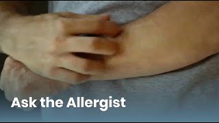 Chronic Hives Triggers and Treatment Ask the Allergist Chronic Urticaria [upl. by Wachtel762]