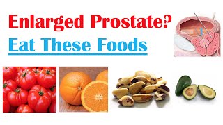 Best Foods to Eat with Enlarged Prostate  Reduce Risk of Symptoms Enlargement amp Cancer [upl. by Htiduj]