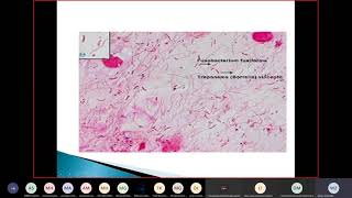 DHB2 Micro Lec 1  Vincent’s angina  Esophigitis  Gastritis  Dr Wafa [upl. by Engle]