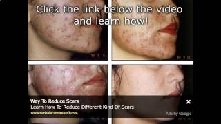 Acne Scar Treatment In The Philippines And AsiaWmv Scar Removal Philippines [upl. by Nnodnarb]