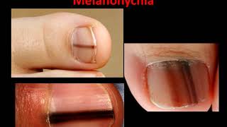 Melanoma Melanonychia  What is it [upl. by Ruhtracm723]