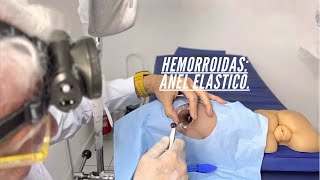 Hemorroidas internas tratadas anel elástico nessa simulação proctologista Dr Paulo Branco [upl. by Aix645]