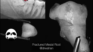 Fractured Mesial Root Step by Step Wisdom Tooth Extraction drwahan [upl. by Hehre]