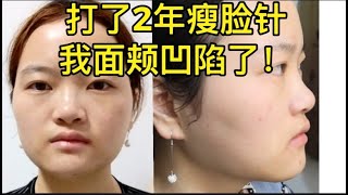 曝光我这2年遭受的瘦脸针后遗症！【整容】 [upl. by Arlyne]