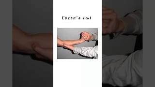 Cozens test kattrucate medicalreels diagnose tenniselbow pressure pain patient shorts [upl. by Cybill620]