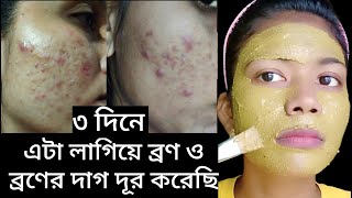 ৩ দিনে ব্রণ ও ব্রণের দাগ দূর করার চ্যালেঞ্জ  ব্রণ দূর করার ১০০ কার্যকরী উপায়। pimple treatment [upl. by Symons662]