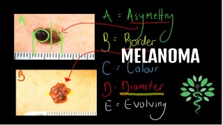 Melanoma  Symptoms signs diagnosis and management [upl. by Goltz492]