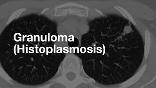 Classic Case Granuloma from Histoplasmosis [upl. by Uella239]