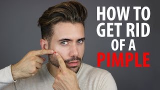 How To Get Rid of a Pimple Overnight  Fast Pimple and Acne Treatments  Alex Costa [upl. by Vig]