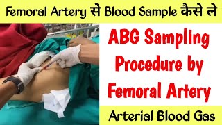 Femoral Artery से Blood कैसे लेते हैं  ABG Sampling Procedure by Femoral Artery  Femoralartery [upl. by Tally]