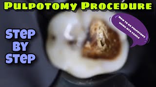 MTA PulpotomyStep By Step [upl. by Atinaw]