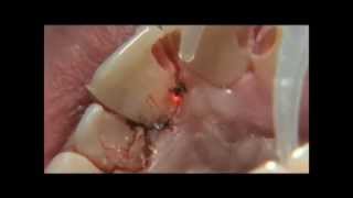 PHILIPS LASERS Eviction gingivale multiple 3wmv [upl. by Estel]