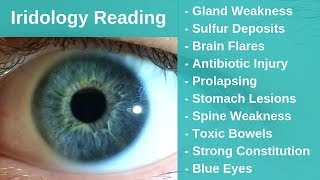 Iridology Reading  Sulfur Drug Deposits and Brain Lesions [upl. by Blanding350]