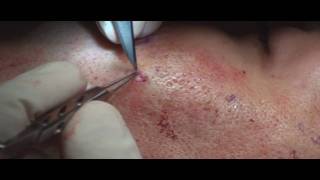 Acne Scar Revision Part 04 More Subcision Technique by Dr Young [upl. by Ardehs]