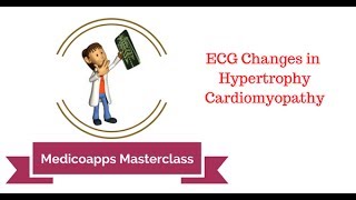 ECG Changes in Hypertrophic Cardiomyopathy [upl. by Ffirahs434]