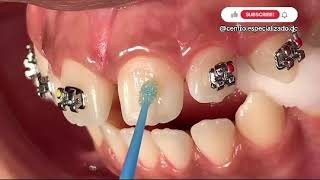 ¡🔥Paso a Paso instalación de BRACKETS 😬 METÁLICOS🔥 [upl. by Althea]