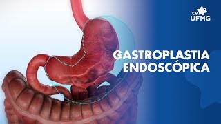 Conheça a gastroplastia endoscópica método de tratamento da obesidade [upl. by Ecirum]