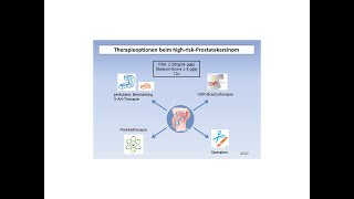 Therapieoptionen beim highriskProstatakarzinom  Strahlentherapie Prof Hilke Vorwerk [upl. by Aikemaj893]